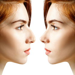 Rhinoplasty